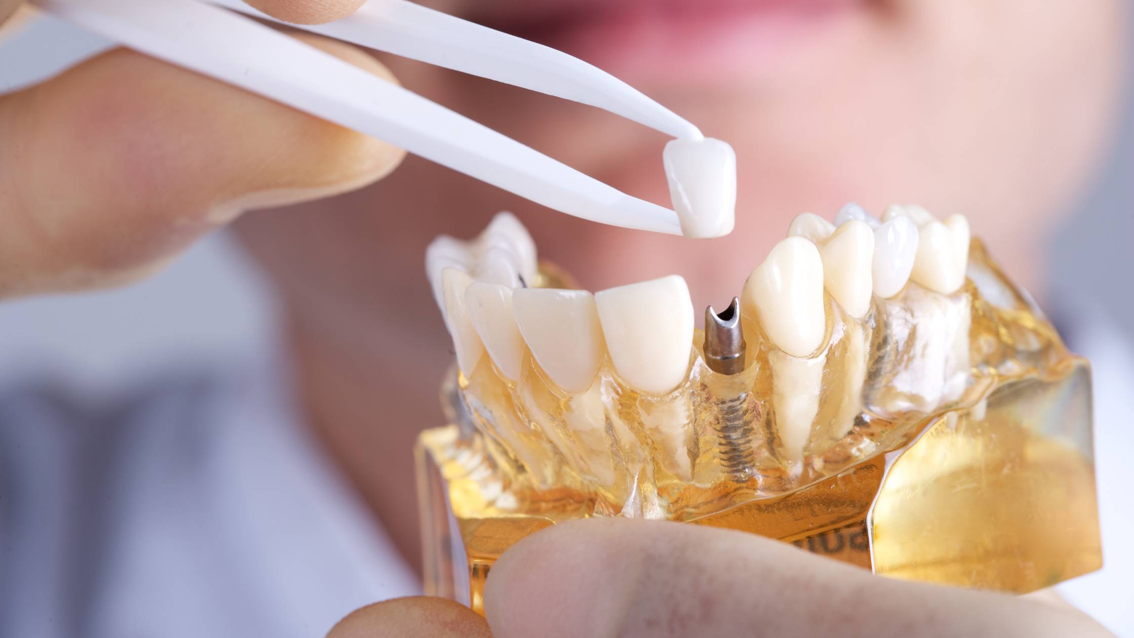 zubni implantati