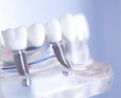 Njega All on 4 implantata nakon ugradnje - Savjeti za dugotrajni osmijeh