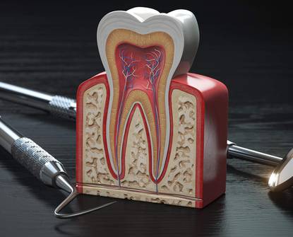 Dubinsko čišćenje zuba - Kako kiretaža može spriječiti gingivitis i parodontitis