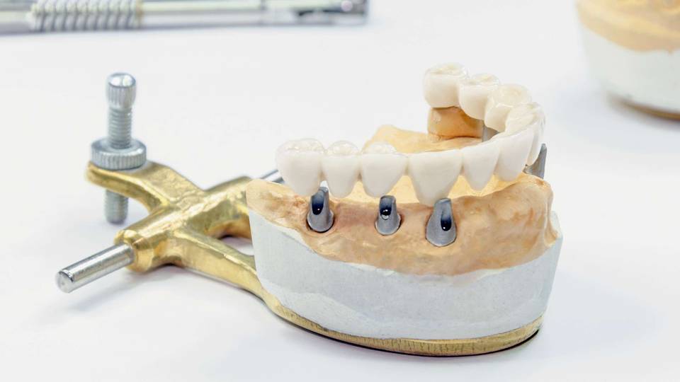 Kako se postavljaju All on 4 zubni implantati - Postupak i što možete očekivati