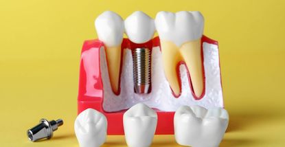 Prednosti zubnih implantata u odnosu na druge metode zamjene zubi