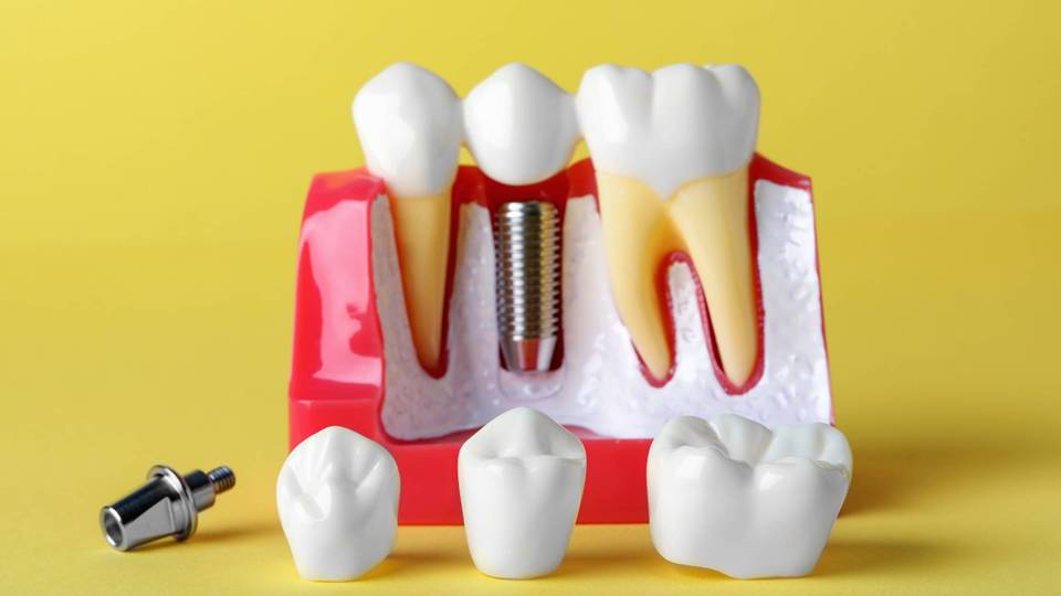 Prednosti zubnih implantata u odnosu na druge metode zamjene zubi