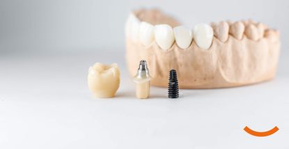 Život sa zubnim implantatima: Održavanje i njega