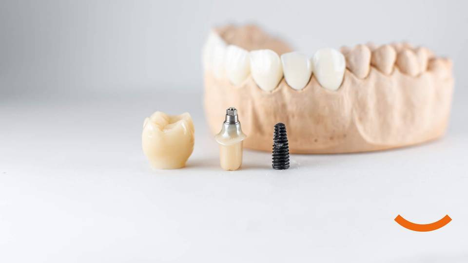 Život sa zubnim implantatima: Održavanje i njega