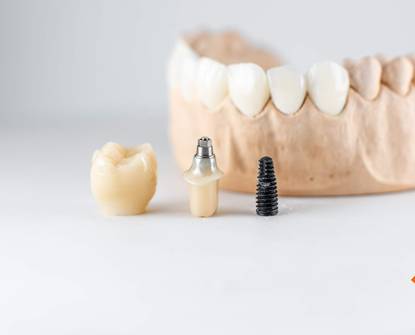 Život sa zubnim implantatima: Održavanje i njega