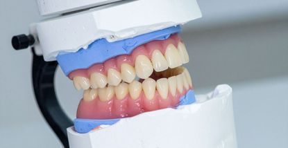 All-on-4 implantati: Prednosti i postupak