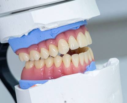 All-on-4 implantati: Prednosti i postupak