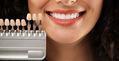 Kako ljuskice za zube mogu transformirati vaš osmijeh