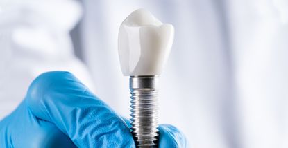 Mini implantati: Kada su dobro rješenje i kome su namijenjeni?