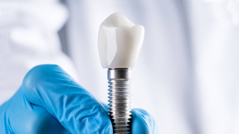 Mini implantati: Kada su dobro rješenje i kome su namijenjeni?
