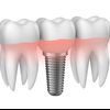 Zubni implantati i oralna kirurgija