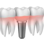 Zubni implantati i oralna kirurgija