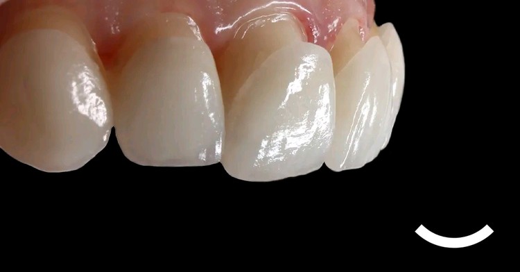 Ljuskice veneers