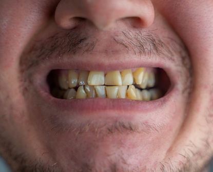 Makeover osmijeha: Kompleksna transformacija osmijeha korak po korak uz Dentico