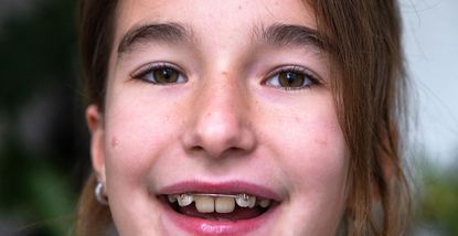 Ortodontske opcije za djecu i adolescente: Kada je pravo vrijeme za aparatić?