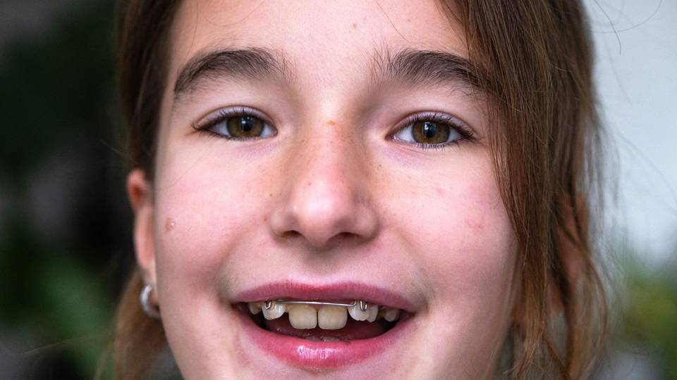 Ortodontske opcije za djecu i adolescente: Kada je pravo vrijeme za aparatić?