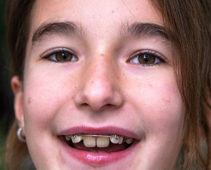 Ortodontske opcije za djecu i adolescente: Kada je pravo vrijeme za aparatić?