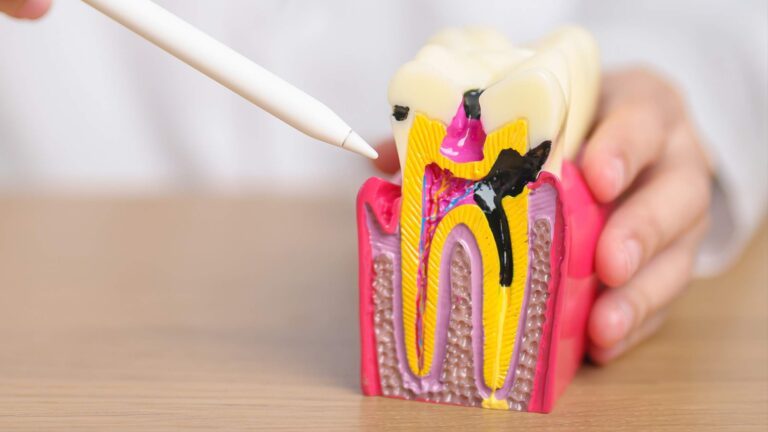 Dubinsko čišćenje zuba - Kako kiretaža može spriječiti gingivitis i parodontitis