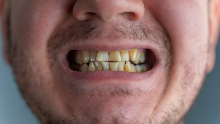 Makeover osmijeha: Kompleksna transformacija osmijeha korak po korak uz Dentico